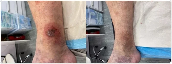 درمان زخم عروقی