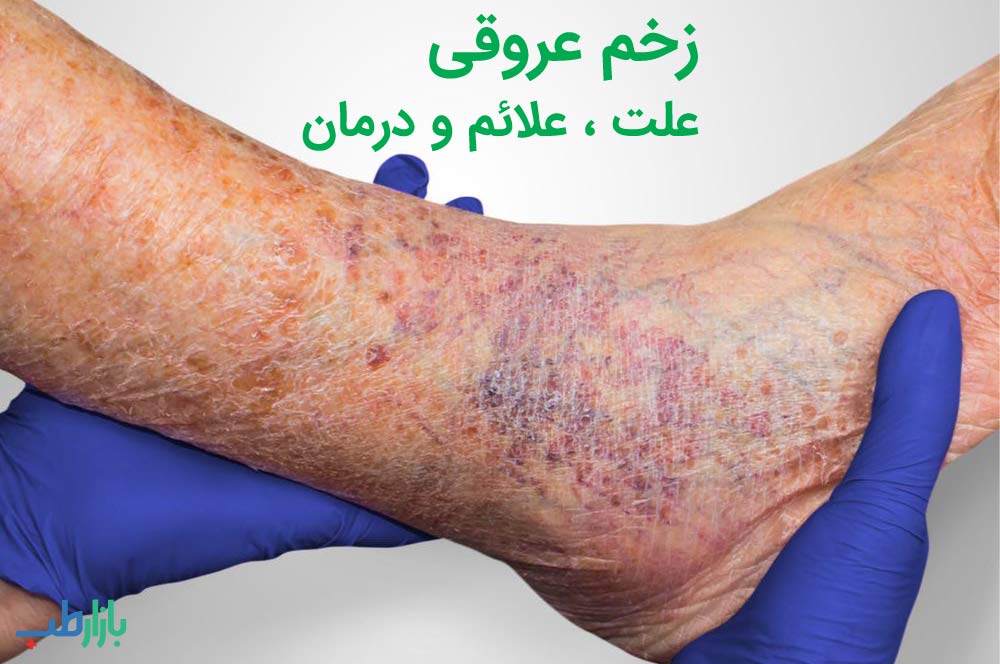 دلایل ایجاد زخم عروقی