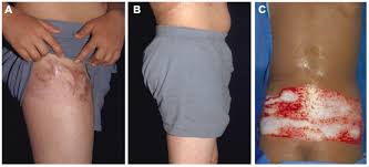 انواع زخم سوختگی