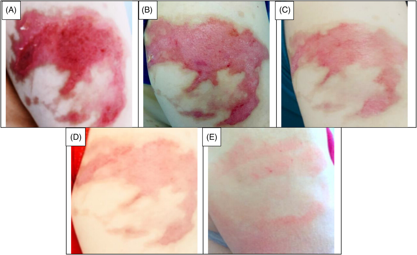 مراحل درمان زخم سوختگی