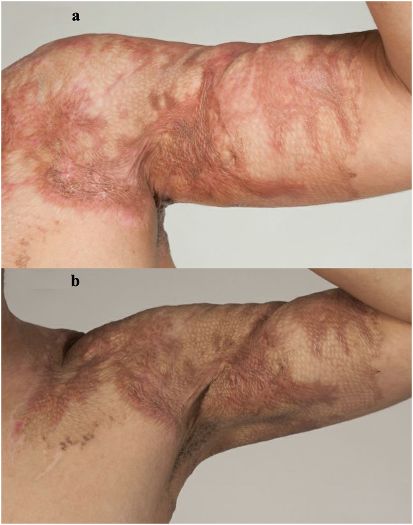 مراحل درمان زخم سوختگی