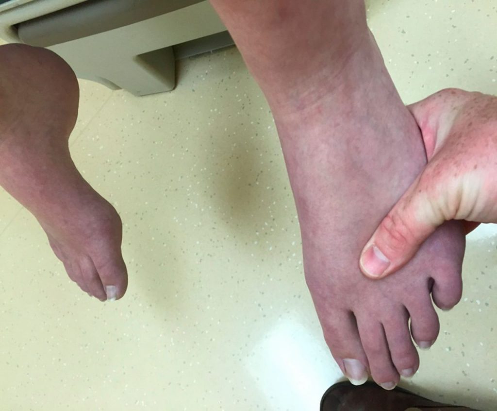 سیاه شدن پای دیابتی