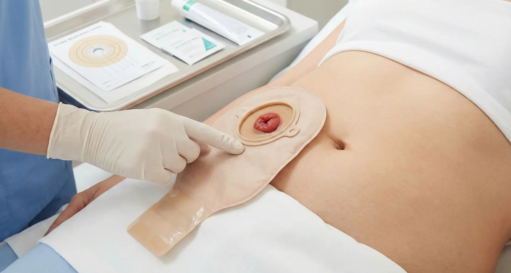 درمان زخم استومی